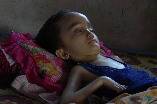 agent orange victim Viet Nam